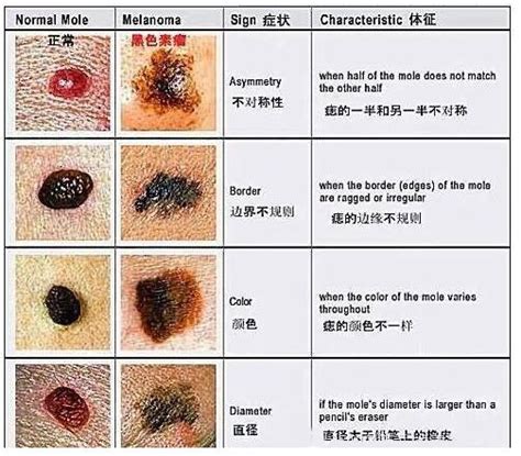 腰上長痣|【腰 痣】腰上長痣命運富貴！財運旺、壽命長，富貴一生